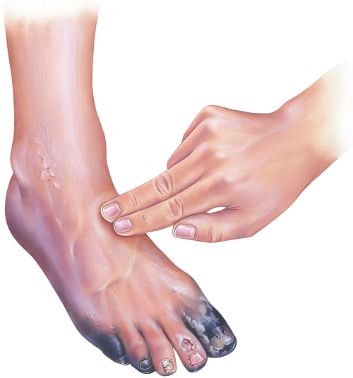 Best Doctor for Gangrene in Andheri, Mumbai